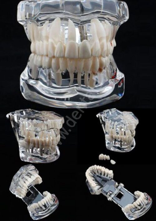 DENT Teeth Model